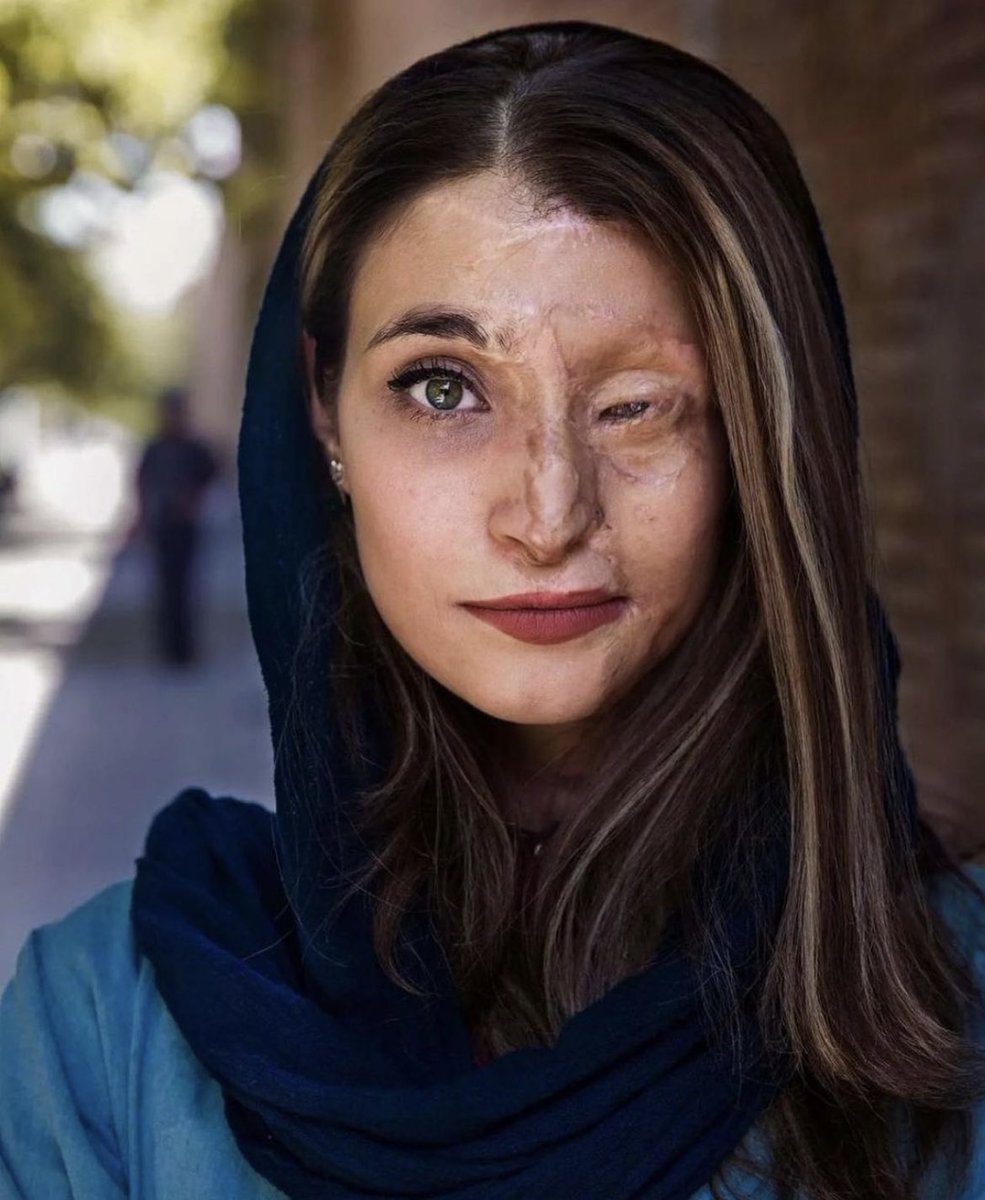In 2014, the city of Isfahan in Iran experienced a series of brutal and horrifying acid attacks targeting multiple women. These attacks, classified as a form of physical violence, involve perpetrators throwing acid at their victims, deliberately aiming for their faces to cause