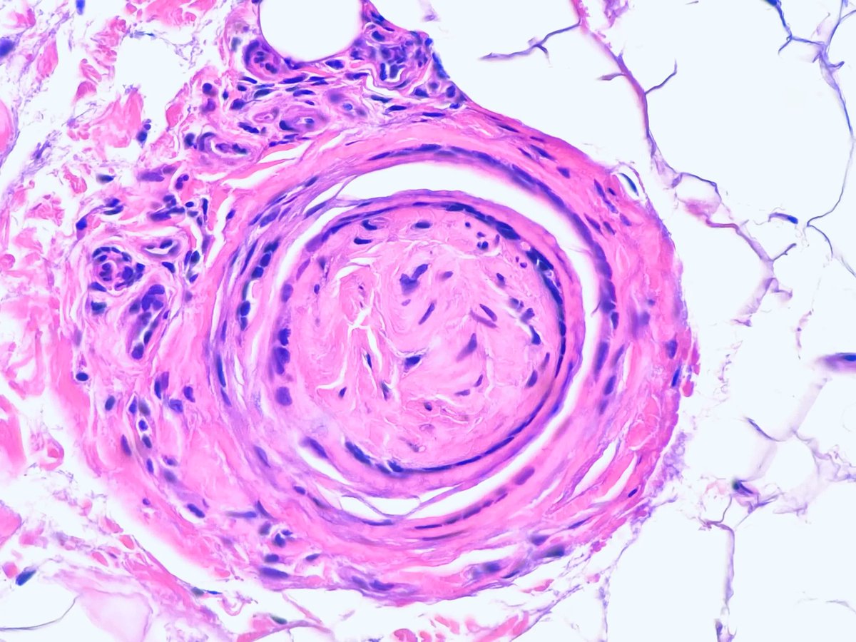 Easy to miss! ⚠️ What's happening here? More pics, immunostains & answer: kikoxp.com/posts/24795 More posts from Dr. @DiegoMoralesN kikoxp.com/diego_morales1 #medTwitter #pathology #pathologists #pathTwitter #dermpath #dermatology #dermatologia #dermtwitter