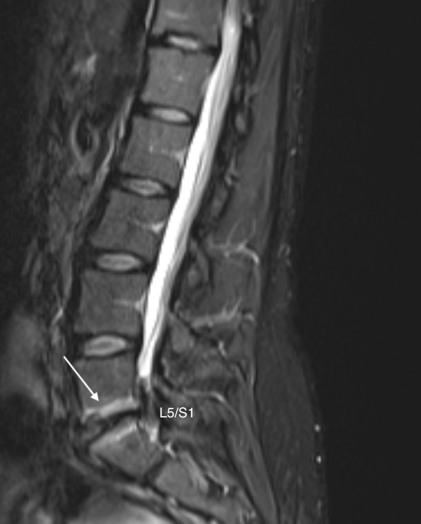 DrJN_SportsMed's tweet photo. Band like LBP that wraps around pelvis into L hip

deep, aching

Referred as ? hip joint pathology

Xray pelvis normal

MRI Lumbar spine &amp; SI joints - Modic 1 end-plate changes biased to left side of disc segment

Recurrent pain pattern seen week on week https://t.co/HCm9Kap0KA