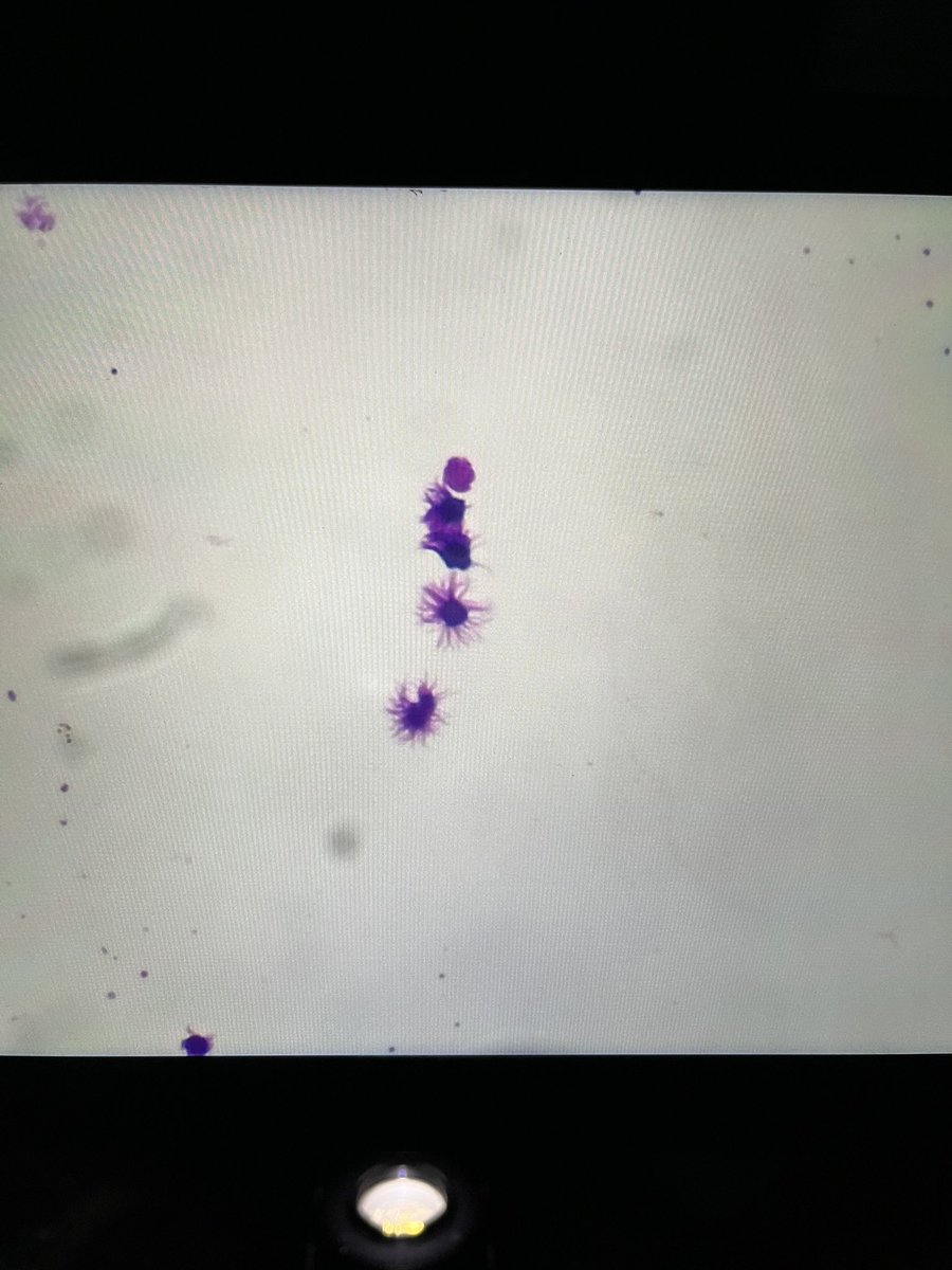 @IBMScience under the microscope 
#AtTheHeartOfHealthcare Ciliary tuft of columnar epithelial cells in ovarian cyst fluid. Stained with Giemsa. #cytology #underthemicroscope #BiomedicalScienceDay #DBTH