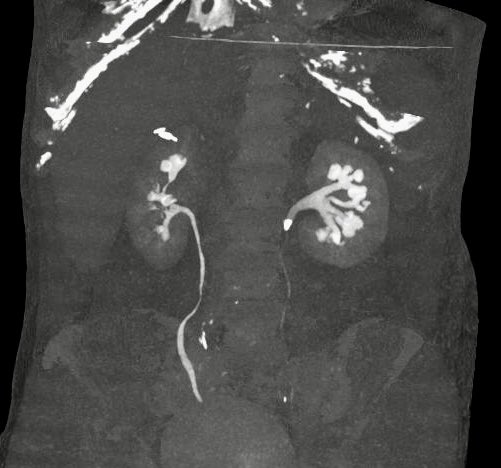 I share such an #iconic CT scan of a 1 cm proximal ureteral stone.
Mild #hydronephrosis.
Patients rarely symptomatic (urine still outflows somehow).
Negative blood tests.