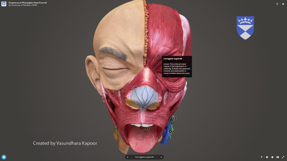 So hat happens when you have tonsillitis?

Explore this stunning 3D model of a patient with ‘strep throat’ @UoDCAHID.

superbugs.online/infections

🦠🤒