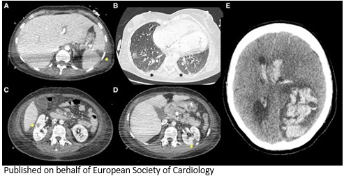 European Society of Cardiology Journals (@esc_journals) on Twitter photo Fulminant biventricular multivalvular infective #endocarditis in complex congenital heart disease bit.ly/3qgj8Q9
#EHJCaseReports <a href="/KardiologieHH/">Erik Rafflenbeul</a> <a href="/aayshacader/">Aaysha Cader</a> <a href="/ANazmiCalik/">A.Nazmi Calik</a> <a href="/TJ_Yeo/">Tee Joo YEO</a> <a href="/Phiso_de/">Philipp Sommer</a> <a href="/EHJCREiC/">EHJCaseReports Editor-in-Chief</a> <a href="/FarhanaAra/">Farhana</a> Fulminant biventricular multivalvular infective #endocarditis in complex congenital heart disease bit.ly/3qgj8Q9
#EHJCaseReports <a href="/KardiologieHH/">Erik Rafflenbeul</a> <a href="/aayshacader/">Aaysha Cader</a> <a href="/ANazmiCalik/">A.Nazmi Calik</a> <a href="/TJ_Yeo/">Tee Joo YEO</a> <a href="/Phiso_de/">Philipp Sommer</a> <a href="/EHJCREiC/">EHJCaseReports Editor-in-Chief</a> <a href="/FarhanaAra/">Farhana</a>