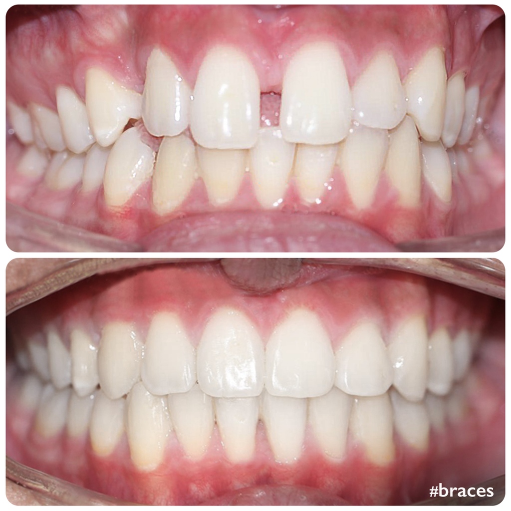 doctor_michaels's tweet image. #SmileTransformed!

This patient had #gaps in his #upperteeth &amp;amp; an #impactedcanine, affecting his #smileline.

Fortunately, Dr. Teertha Karnakar our expert #orthodontist performed a surgical procedure &amp;amp; worked with #braces to correct the #teethmisalignment and return his smile.