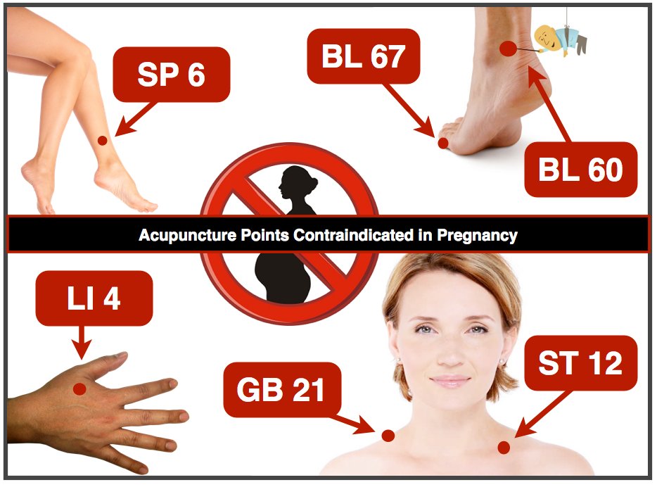 AcuProAcademy's tweet photo. ⭐️#Acupuncture during #pregnancy is safe and very beneficial!🤰🏻

The abdomen &amp; lumbar regions should not be needled and these 6 can ONLY be used at the end of pregnancy safely, during difficult labor and/or for cervical ripening, if deemed necessary.

#cervicalripening https://t.co/GDec39HAjD