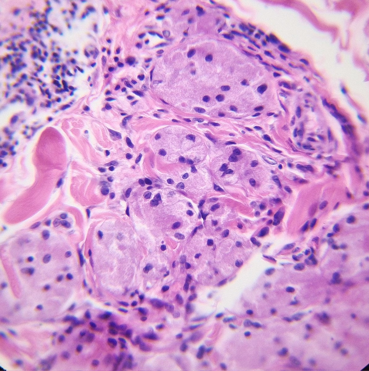Today's interesting case: Granular cell tumor 🔬 

#dermpath #PathTwitter