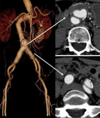 Last one of the evening! Q4: When would U consider EVAR appropriate for VEDS? Does your approach to endo mgmt differ from non-VEDS AAA pts? #AortaED #JVSCITTweetChat @JamesHBlackMD @peterjrossi @ShereneShalhub @umwgal @GustavoOderich