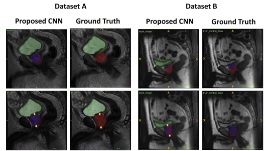 Congrats @MelinaHosseiny and our collaborative team including @TylerSbrt on this award-winning paper on #AI #multitasking applied to prostate #MRI in @Applied_Rad! These #imagingAI innovations allow us to advance precision therapy @UCSDHealth. appliedradiology.com/Articles/multi…