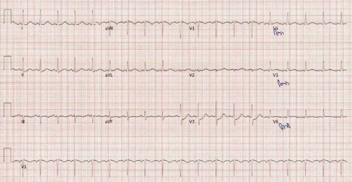 Late 30s female. Few months of chest pain acutely worsened prior to arrival. Pleuritic and worse with supine position but also exertional and alleviated with rest. 2nd ECG has posterior leads and was done 2hr later. Answer in thread #ECG #EKG #medtwitter #cardiotwitter #FOAMEd