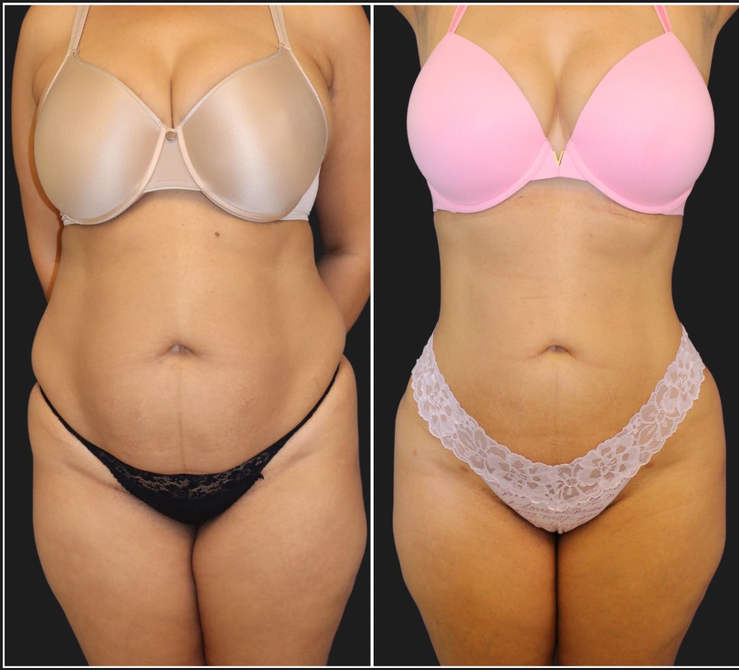 drmuniquemaia's tweet photo. Can you believe this isn’t a tummy tuck? 😮 

3️⃣8️⃣ year-old mother of 2 after #360lipo, #bodytite to the abdomen, and a #bbl (#fattransfer to the buttocks)

She looks and feels great! #plasticsurgery #maiaplasticsurgery https://t.co/L8Nh7QUFmB