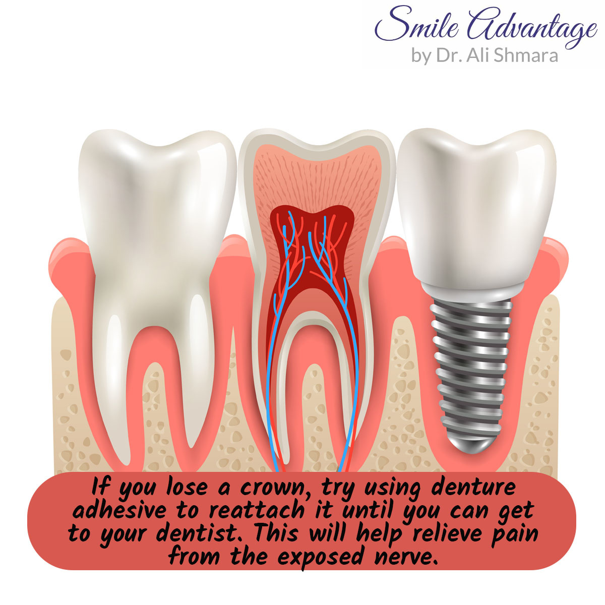 DrShmara's tweet photo. Dental wax can be a life saver in this situation! https://t.co/omVO95j8Nh