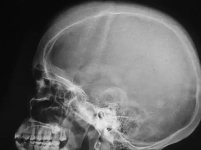medizzycom's tweet photo. The "hair on end sign" is attributed to:
- thalassemia major;
- iron deficiency anemia;
- sickle cell disease;
- hereditary spherocytosis.

Shared in the MEDizzy App: https://t.co/BIZKfdE51J

#medicine #medicaleducation #radiology #xray #anemia #hematology https://t.co/AwmL8aN0lS