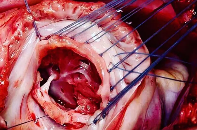 medizzycom's tweet photo. The tricuspid valve is on the right dorsal side of the mammalian heart, between the right atrium and the right ventricle. The function of the valve is to prevent back flow of blood into the right atrium.

Shared in the MEDizzy App: https://t.co/dLJleT3H6K

#medicine https://t.co/TWOXZ2tSQY