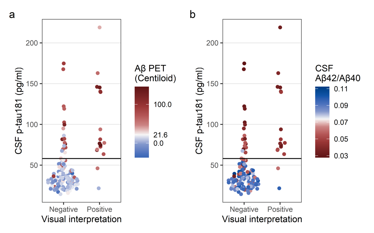@WUADRC @WashUNeurology 18F-flortaucipir PET visual interpretation was found to be moderately consistent with CSF p-tau181 (n = 124/144, 86.1%, κ= 0.526). Most discordant cases (n = 18/20) are amyloid-positive and CSF p-tau181 positive, but tau-negative on visual interpretation (8/n)