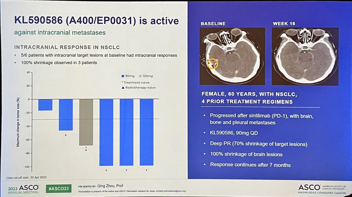 Tony_Calles's tweet photo. 🎯 🧬 KL590586 (A400/EP0031)
A next-generation selective RET inhibitor in patients with RET-altered solid tumors. ORR 60% and DCR 95% for all tumor types and doses. 🫁 In NSCLC: ORR 81% in 1L and 70% in 2L. Also 🧠 activity proven #ASCO23 #LCSM https://t.co/J5zoQKsyBu