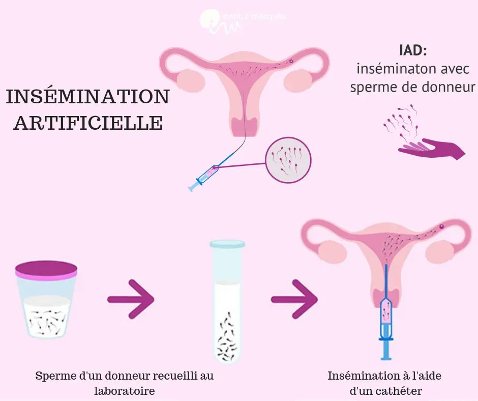 L' #insemination avec don de sperme est un traitement intra-utérin indiqué pour les patients qui n’ont pas de spermatozoïdes capables de produire des embryons normaux.
Comment se déroule une insémination avec don de sperme?
bit.ly/2IBmvuU