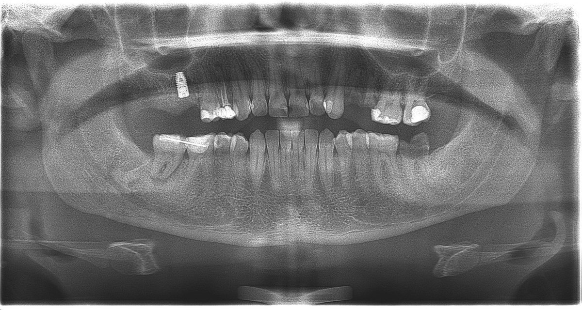 Dr_abubakr1's tweet photo. Autotransplantation
بالعربي البسيط الضرس السابع كان غير صالح ويستدعي الامر خلعه،فأخذنا ضرس العقل بما انه غير مفيد في موقعه الاول واعدنا زراعته في مكان الضرس السابع.
استعملنا تكنيك معين وبإذن الله تعالى بنسبة جيدة ما رح نحتاج علاج عصب لهذا الضرس،وتم خلع الضروس العلوية ووضع زراعة. https://t.co/TpPlwHUuYj