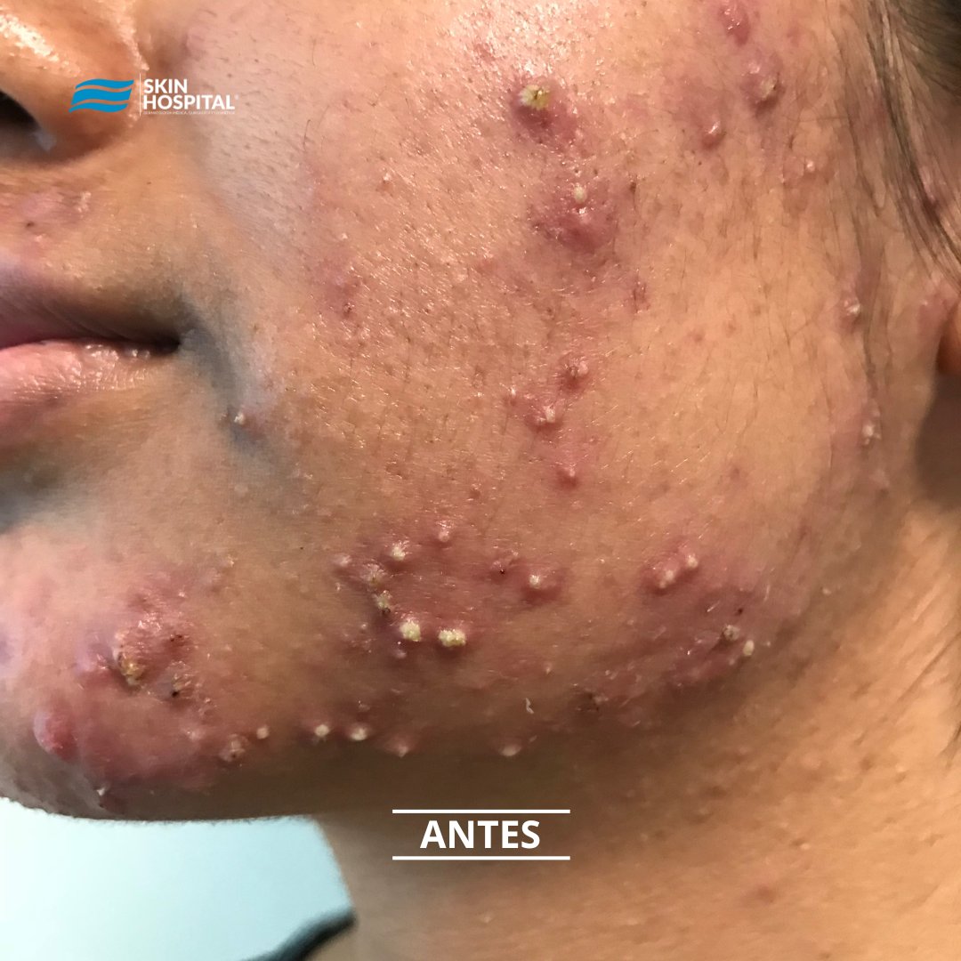 SkinHospital_mx's tweet photo. ACNÉ
Es una enfermedad que se puede producir por muchos factores, incluso cambios hormonales.

Lo mejor es atenderte, evitando molestias y agilizando aún más tu recuperación.

En nuestra clínica contamos con tratamientos para acné, espinillas y puntos negros.  

#acne #espinillas https://t.co/rM1VtRVKp7