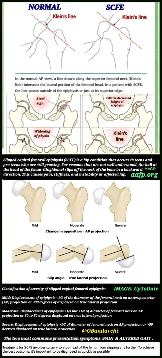 🛑SCFE:At least 2 views hip radiography needed: AP & Lat (frog-leg or cross table lateral).
✴️Golden tips: There're radiologic signs (e.g, 4 of them highlighted),but no matter what ,look for:
👉posterior displacement of femoral epiphysis,like ICE-CREAM SLIPPING OFF A CONE 👍😊