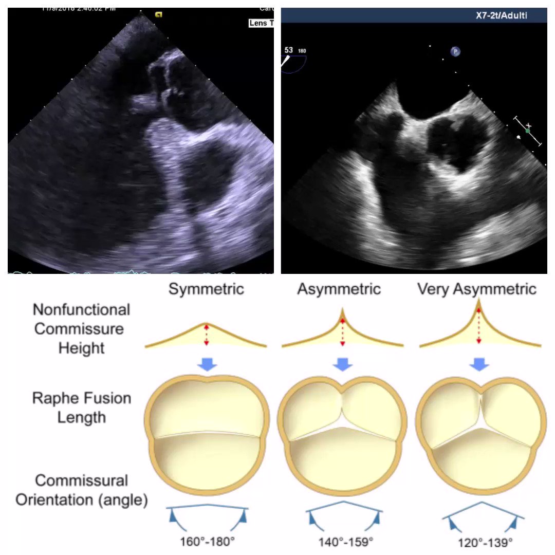 💡 Young male with severe aortic regurgitation in bicuspid aortic valve. Let's see vidoes pre and post-repair. What about the role of 2D/3D TOE in aortic valve repair? Which measurements we need to calculate and how to calculate? Annuls dimension, commissural orientation,…