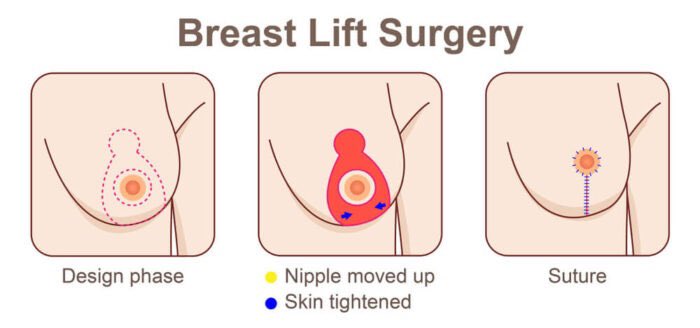 𝐎𝐭𝐡𝐞𝐫 𝐬𝐮𝐫𝐠𝐞𝐫𝐢𝐞𝐬 𝐢𝐧𝐜𝐥𝐮𝐝𝐞:

♡ Brachioplasty (Arm Lift) 4-6k

♡ Thighplasty (Thigh Lift) 5k

♡ Breast Lift 5k 

These costs don’t include: anesthesia,