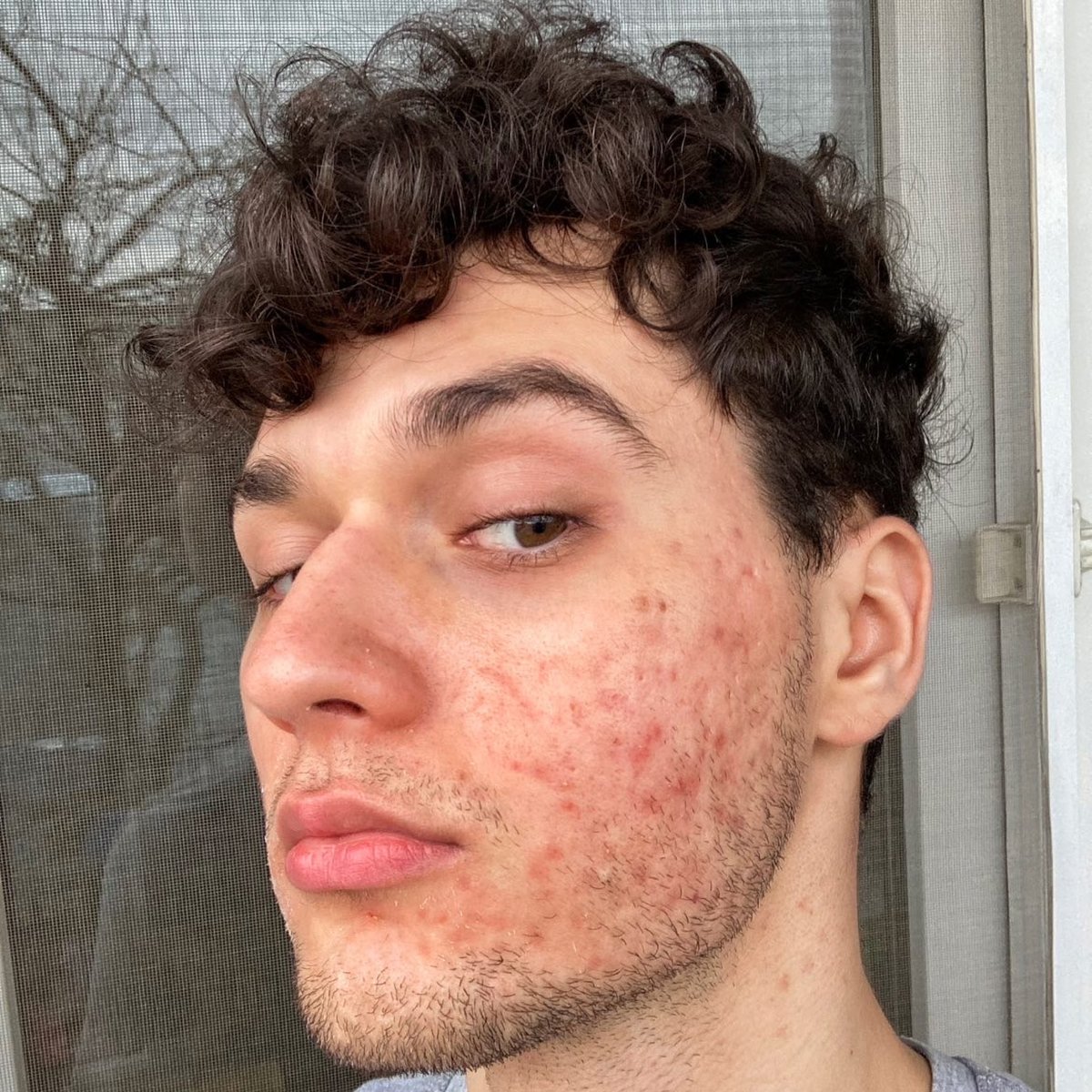 herocosmetics's tweet photo. Reminder: You’re beautiful with or without acne, texture, hyperpigmentation, etc. and we 🫶 you ✨

#AcneAwarenessMonth
📸: @spottylittlething , @ratughania, @scarryacne_with_v, @selflove_aida on IG
#HeroPartner https://t.co/BJnnBzjQL8