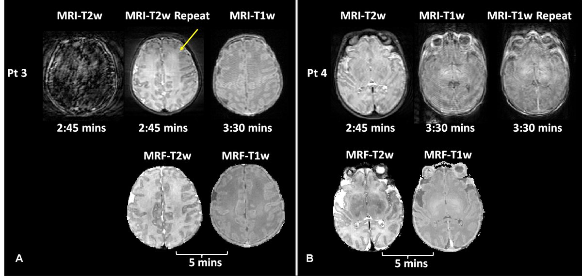 MRI_Dan's tweet image. Check out our 'motion robust MRF for non-sedated infant imaging!' presented by @MRI_ChaitraB, and featured as 1 of the top 100 abstracts at @ISMRM this year!  Our non-sedated subjects are those with prenatal opioid exposure. Abstract No. 0045