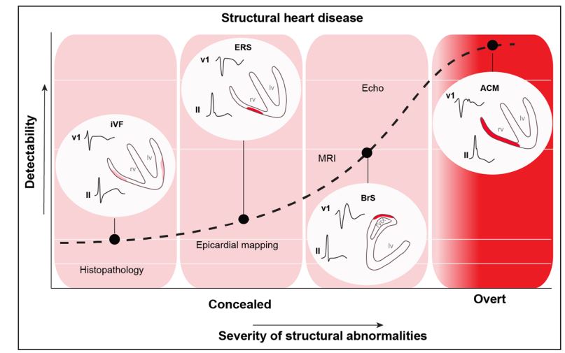 Igor Morr (@igormorr) on Twitter photo Subepicardial Cardiomyopathy: A Disease Underlying J-Wave Syndromes and Idiopathic Ventricular Fibrillation.this results in reduced epicardial conduction reserve, facilitating an arrhythmogenic substrate ahajournals.org/doi/pdf/10.116… <a href="/siac/">siba siac</a> <a href="/Lawebdelasalud1/">La web de la salud</a> <a href="/meza0208/">yolimar meza</a> <a href="/MiSaludTotal/">SALUD TOTAL</a> Subepicardial Cardiomyopathy: A Disease Underlying J-Wave Syndromes and Idiopathic Ventricular Fibrillation.this results in reduced epicardial conduction reserve, facilitating an arrhythmogenic substrate ahajournals.org/doi/pdf/10.116… <a href="/siac/">siba siac</a> <a href="/Lawebdelasalud1/">La web de la salud</a> <a href="/meza0208/">yolimar meza</a> <a href="/MiSaludTotal/">SALUD TOTAL</a>