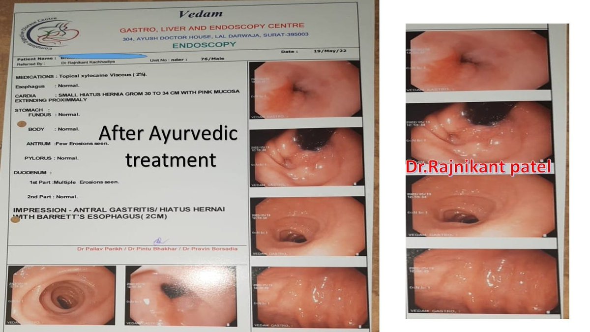 ***Case of Necrosed Oesophagus, Treated completely with Ayurvedic treatment***

75 year Male
C/o Blackish and brown colour vomiting , nausea, epigastric pain, weakness and difficulty in breathing since 3 months..
Went to hospital and advised for Oesophago-Gastro-Duodenoscopy…