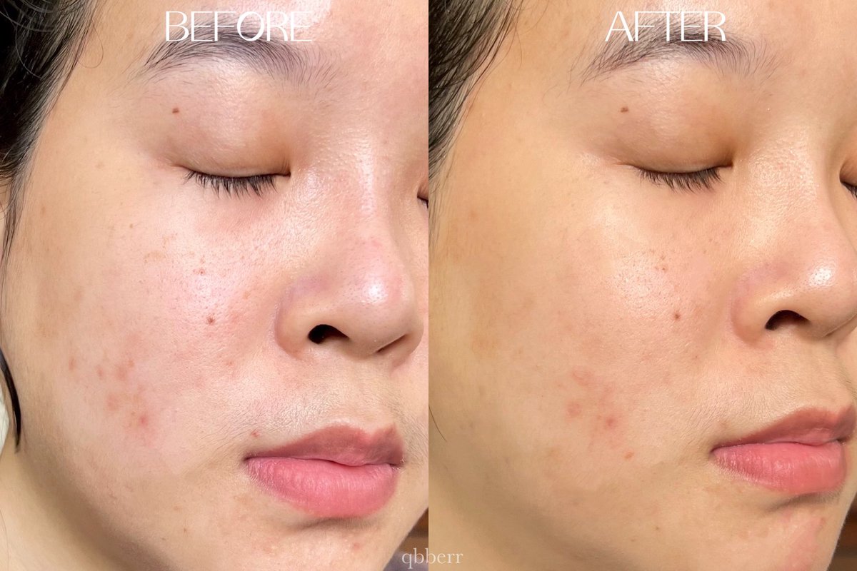 qbberr's tweet photo. ฝ้า กระ จุดด่างดำจางลงเพราะได้ตัวนี้ช่วย Mela Bright C+ Serum ของ #Alphascience✨ เซรั่มที่จะช่วยลดฝ้าเรื้อรัง จุดด่างดำที่ฝังลึก ปรับผิวหน้าให้กระจ่างใสขึ้น แถมปกป้องไม่ให้เกิดขึ้นอีกด้วย! และตัวนี้ยังใช้ได้กับทุกสภาพผิว ดีบอกต่อ💘
#ใช้จริงรีวิวจริง #ไว้รีวิวห้ามขายของของโว้ยย https://t.co/m71VL1V6sm
