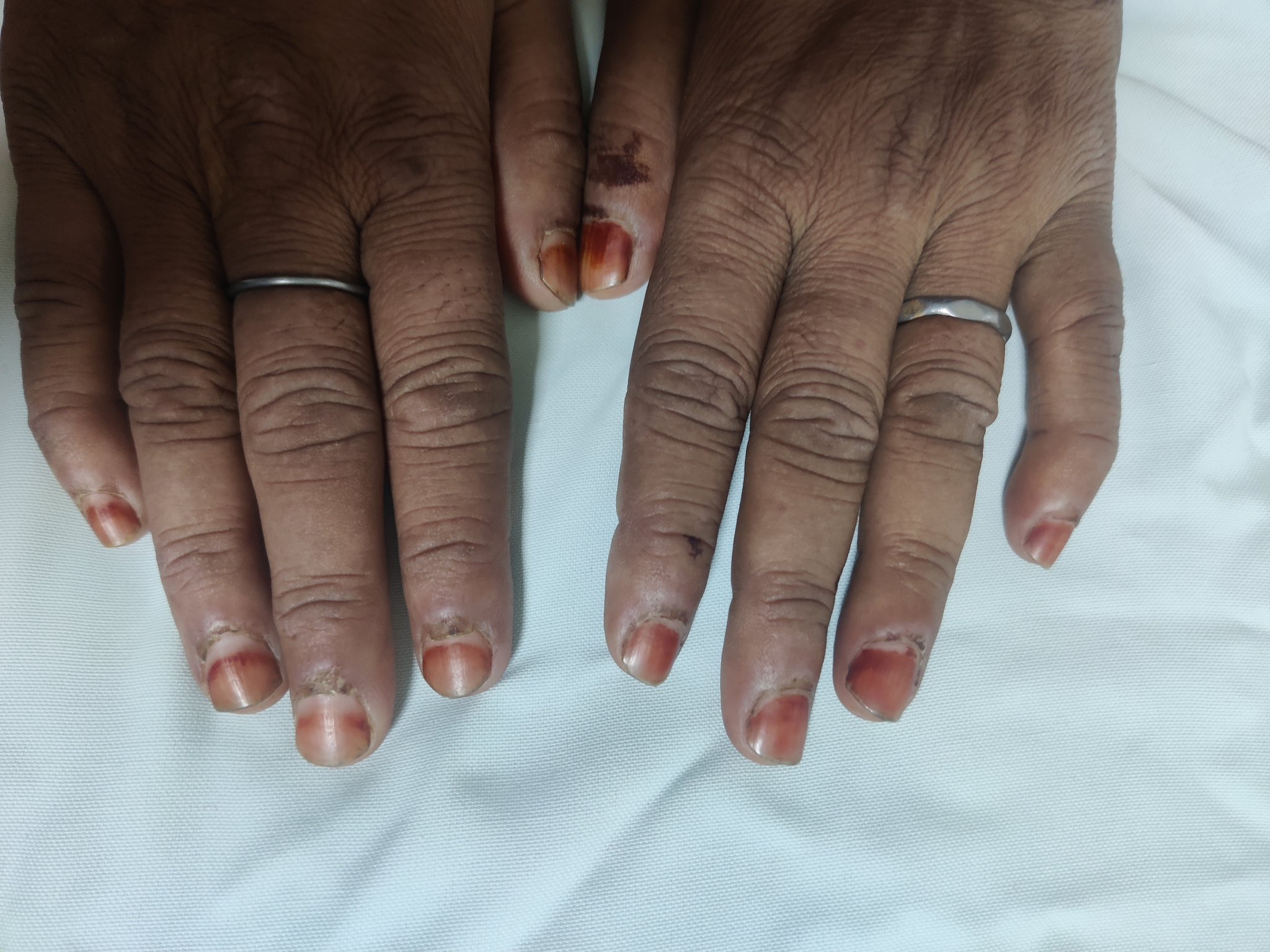 How to get rid of dark skin around the nails in just 7 Days - YouTube