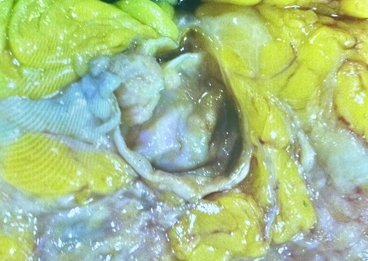 The art of grossing. A 54 yo woman presented with a  right breast palpable mass and bloody discharge. A lumpectomy was performed.Final Dx. Intracystic Papillary Carcinoma #pathology #pathresidents #pathTwitter #breast #tumors