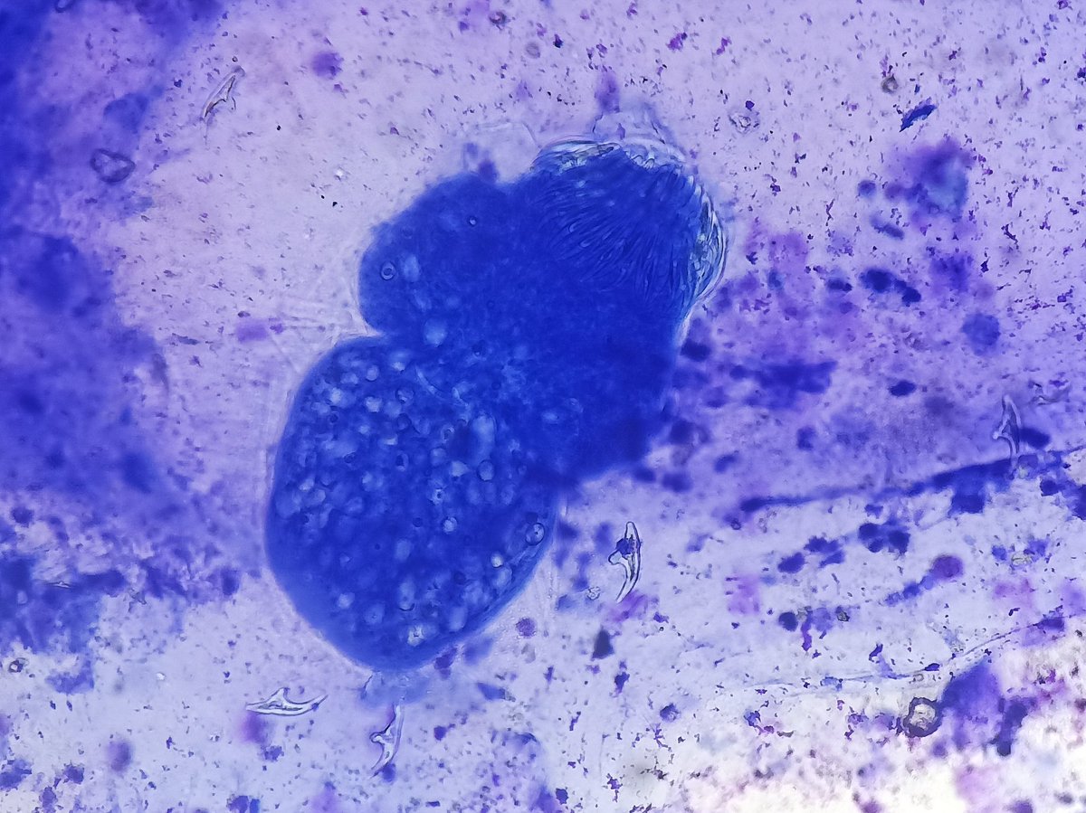 35 years female, FNAC from left breast lump.