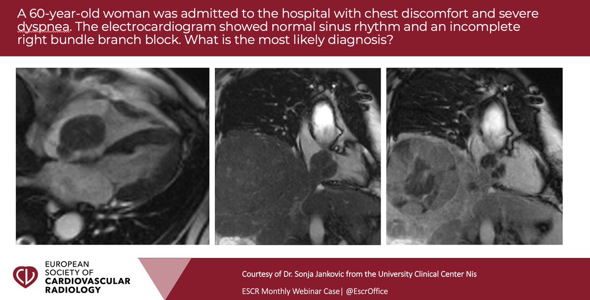 EscrOffice's tweet photo. Time for our next webinar case 🫀🧐

❓What is the most likely diagnosis ❓

Join our upcoming webinar "Cardiac masses and cardio-oncology" on June 14, 18:00 CEST for the solution 🤩👇

https://t.co/V4CS9Qr6s1

@sonja_janx #escr #radres #radiotwitter #radtwitter #oncology https://t.co/K38H0yU2Ng