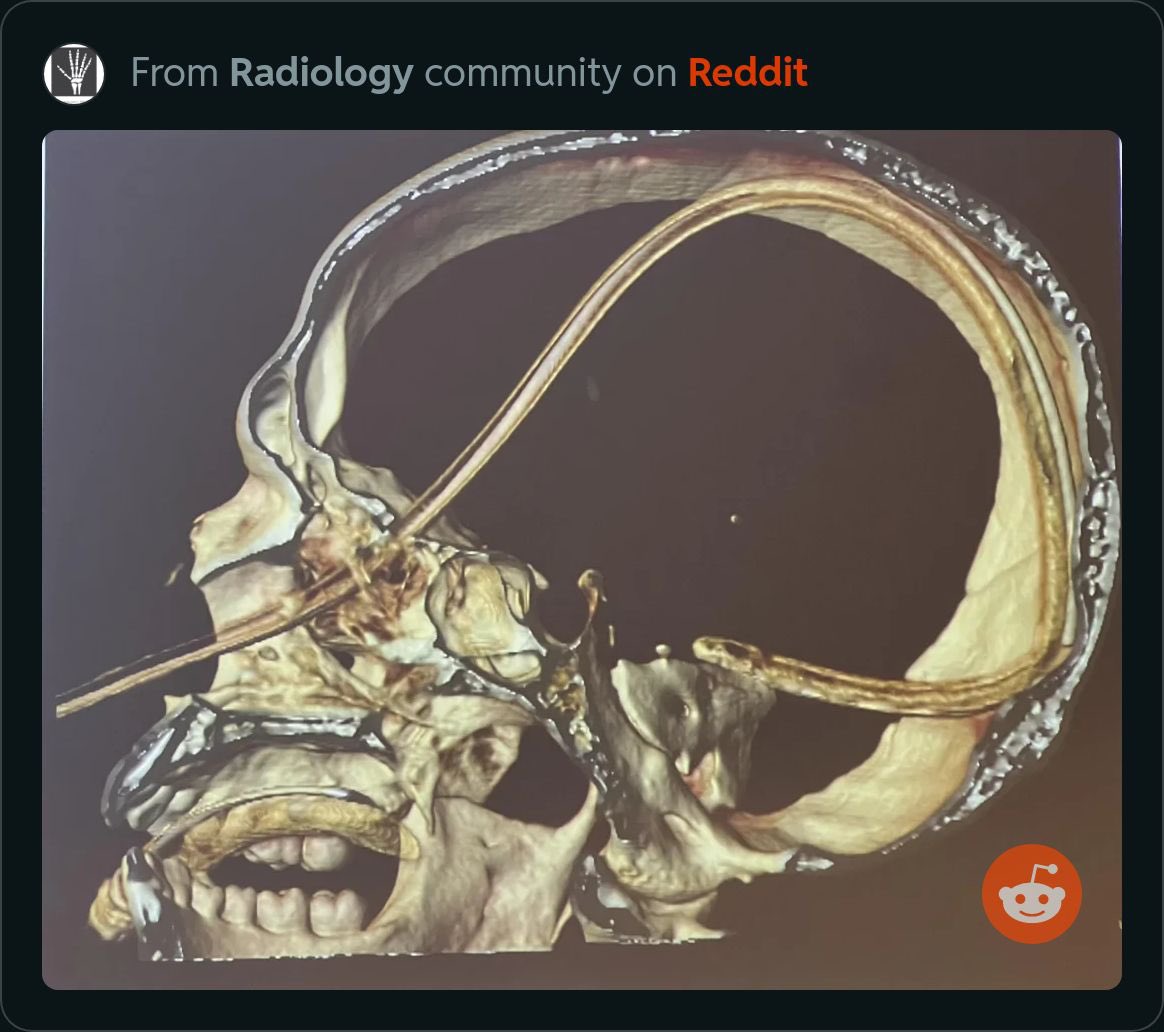 Be very careful when inserting these… diagnosis?  What happened?  Tips for the med student and pgy-1’s starting soon?