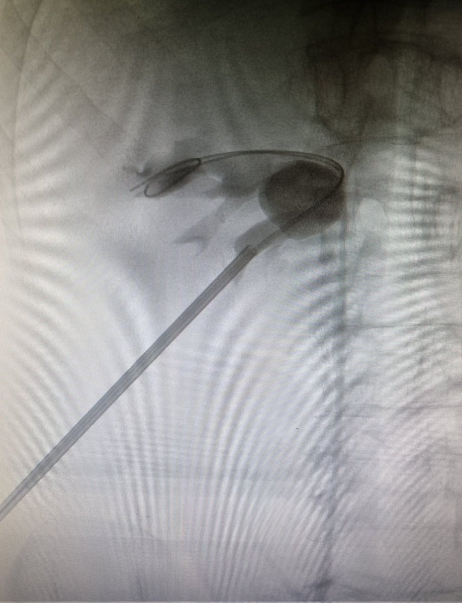 drmarcoscepeda's tweet photo. Supine #PNL workshop at HURH. Staghorn, large proximal ureteral stone and complex lower calyx. #Miniperc and conventional approach. Thanks to my team for the effort and @CookMedical for the support! https://t.co/SfC2ZA8EQD