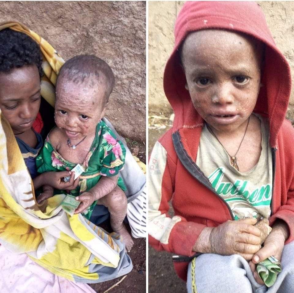 feven___21's tweet photo. #Humera_Now These children were displaced from #WesternTigray Setit Humera, apart from hunger,the disease they suffer from is very serious "We can't do anything because we don't have treatment, we beg for food every day #TigrayGenocide😢
@AsstSecStateAF @PowerUSAID @WFPChief @hrw https://t.co/gxu8efeov2