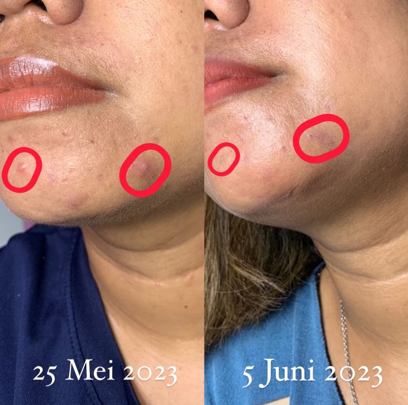Dchangeskincare's tweet photo. Siapa yang pernah merasakan sakit pada jerawat akibat peradangan serta ada kemerahan juga.
AKU SERING,!
#racuninskincare #SkintificGelMoist https://t.co/2j3TtSVKXl