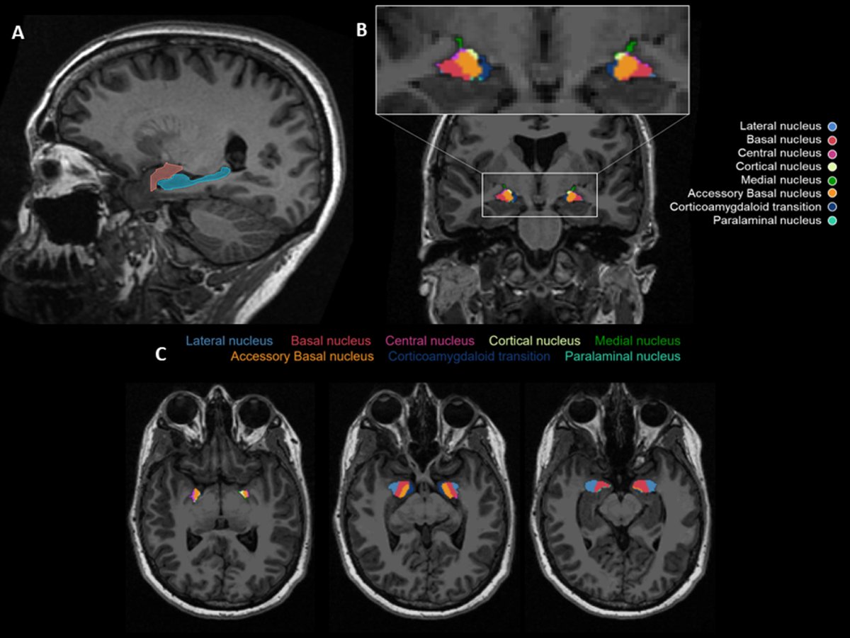 New in the #RedJournal: 1st study showing assoc btwn amygdalae morphometry, inc nuclei, and neurocog/neuropsych outcomes. Atrophy was progressive &amp; predicted poorer emotional wellbeing, memory, and anxiety symptoms <a href="/UCSDRadMed/">UC San Diego Rad Med</a> <a href="/JHGLab/">Jona Hattangadi-Gluth, MD</a> @MSalans bit.ly/hatglu1
