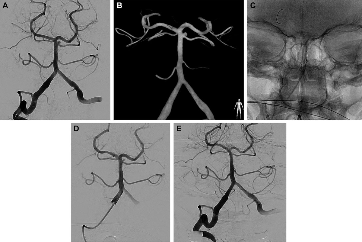 JNIS (@jnis_bmj) on Twitter photo Latest content: bit.ly/3Nby9vF Srinivasan et al demonstrate high occlusion and low complication rates with flow diversion treatment of basilar quadrifurcation aneurysms <a href="/visishs/">Visish M. Srinivasan, MD</a> <a href="/fcalbuquerque51/">Felipe C. Albuquerque</a> #Aneurysm #Flowdiversion #PosteriorCirculation Latest content: bit.ly/3Nby9vF Srinivasan et al demonstrate high occlusion and low complication rates with flow diversion treatment of basilar quadrifurcation aneurysms <a href="/visishs/">Visish M. Srinivasan, MD</a> <a href="/fcalbuquerque51/">Felipe C. Albuquerque</a> #Aneurysm #Flowdiversion #PosteriorCirculation
