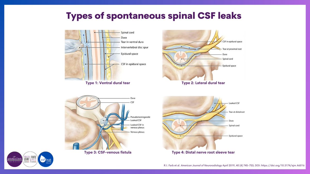 spinalCSFleak's tweet image. For #LeakWeek day three, we’re discussing causes of spinal CSF leak. Here are some examples of types of spontaneous leaks. 

spinalcsfleak.org/leakweek-2023-… 

#leakweek2023 #spinalcsfleak #becauseyourduramaters