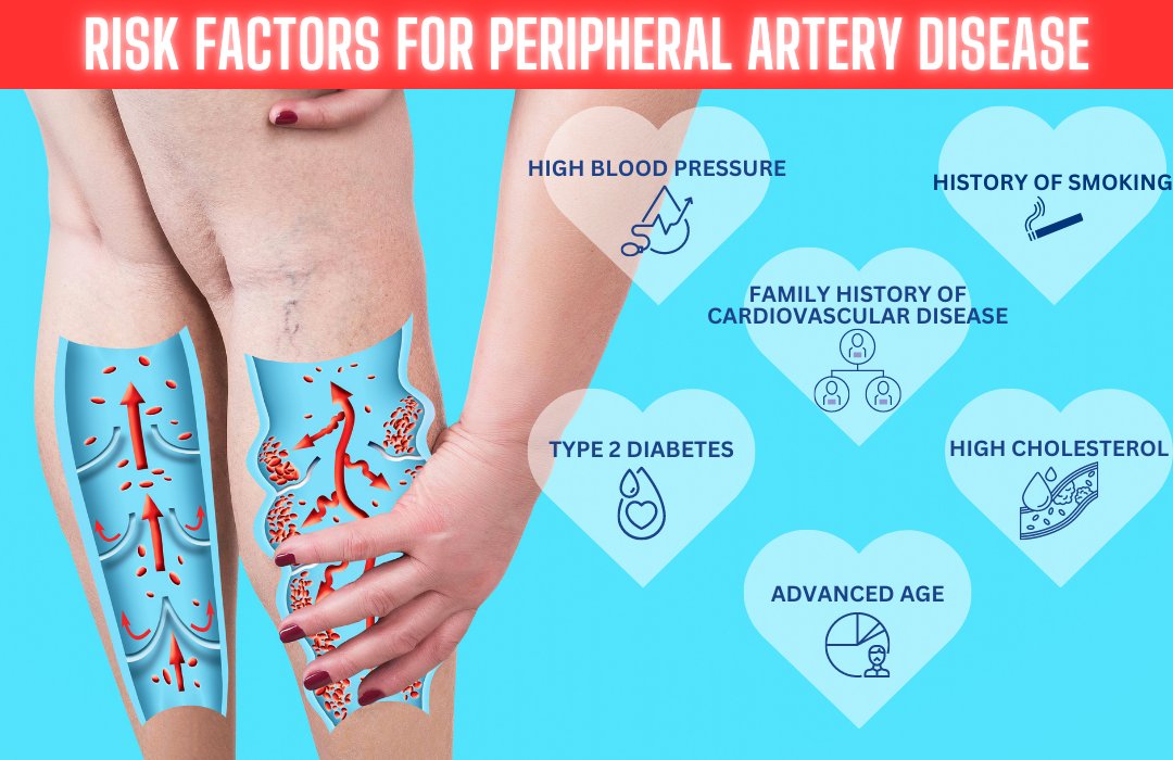 Don't ignore the risk factors for peripheral artery disease! Learn why early testing is crucial to saving lives and limbs: bit.ly/3oRCJWz #PeripheralArteryDisease #PADtesting #betteroutcomes