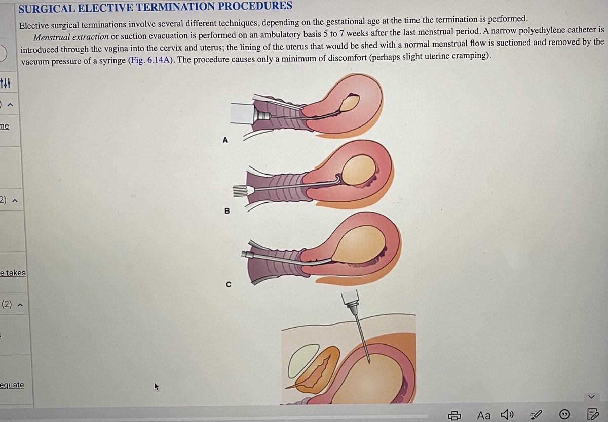 The image does not show the fetus. It shows the cervix, the uterus, the placenta, and the chorion. 

It sounds like that nursing student needs to focus more on her studies.