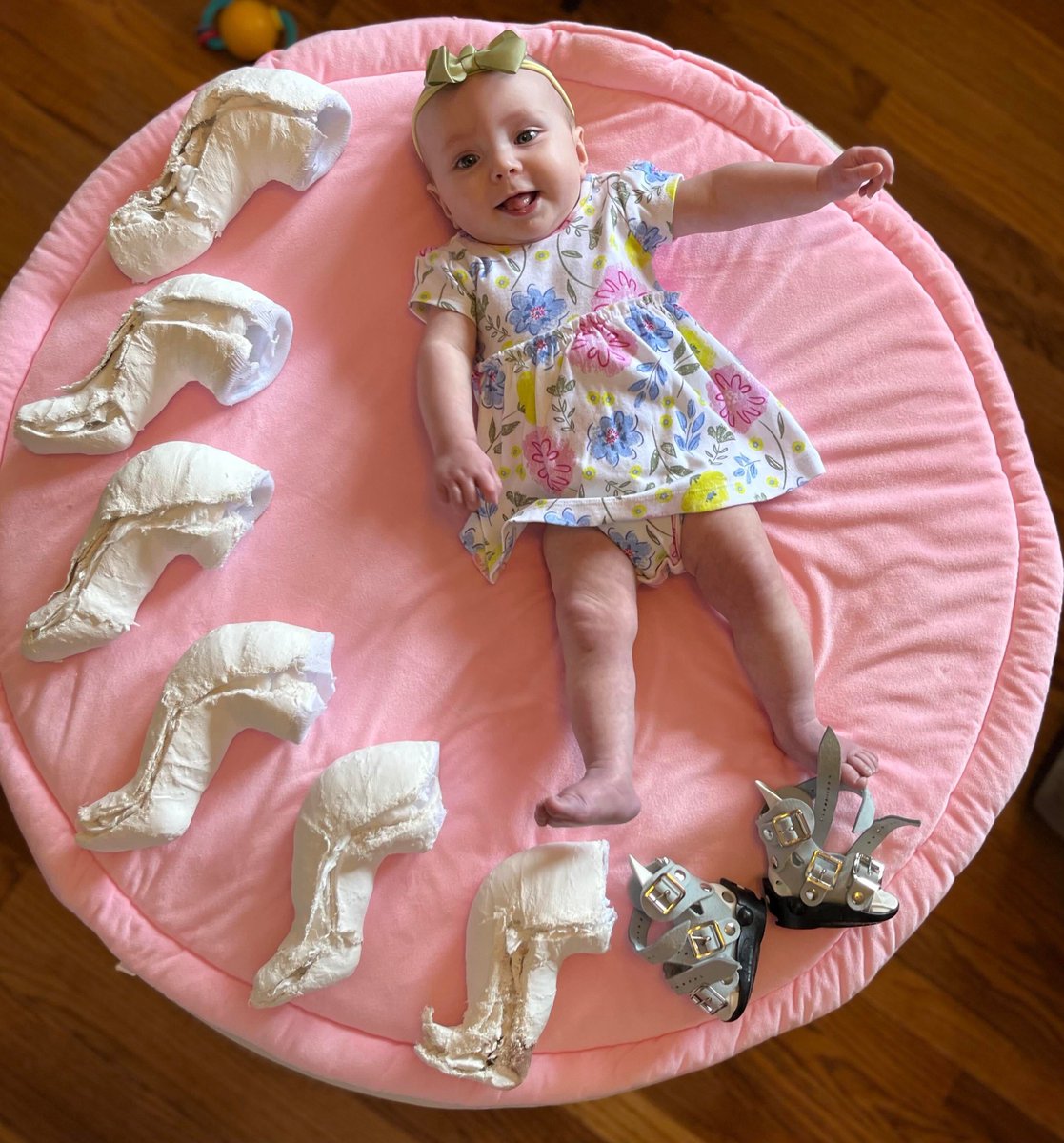 UI Health Care Stead Family Children's Hospital (@uichildrens) on Twitter photo Did you know that the Ponseti Method—the modern treatment for clubfoot—was developed at <a href="/uiowa/">University of Iowa</a> in the 1950s?
Learn how the Ponseti Method continues to help children like six-month-old Delainee live active, normal lives: spr.ly/6015OaAaJ Did you know that the Ponseti Method—the modern treatment for clubfoot—was developed at <a href="/uiowa/">University of Iowa</a> in the 1950s?
Learn how the Ponseti Method continues to help children like six-month-old Delainee live active, normal lives: spr.ly/6015OaAaJ