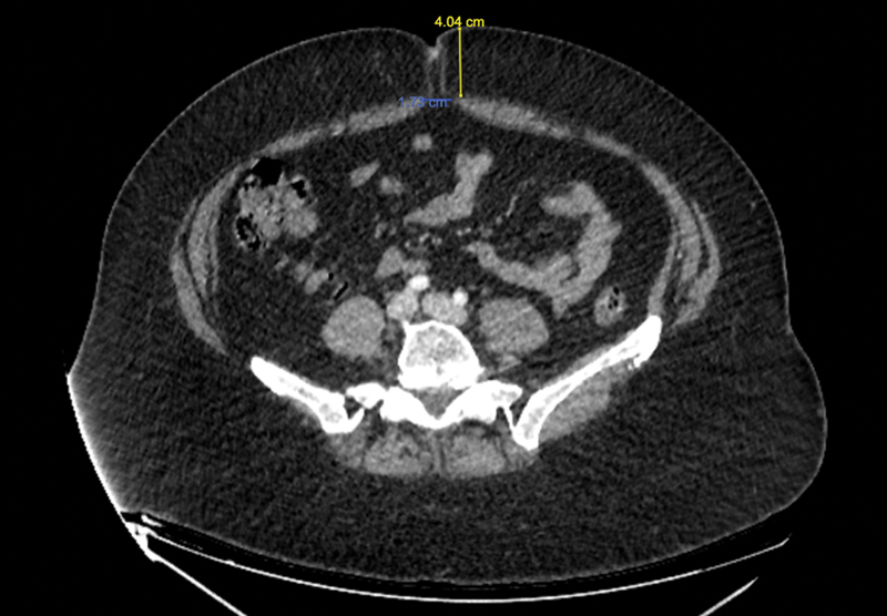 ThiemePlasticS's tweet image. The purpose of this study is to delineate predictors of donor site #morbidity following deep inferior #epigastric #perforator flap harvest and use those predictors to develop a #MachineLearning model that can identify high-risk patients:
📎 thieme-connect.com/products/ejour…
#plasticsurgery
