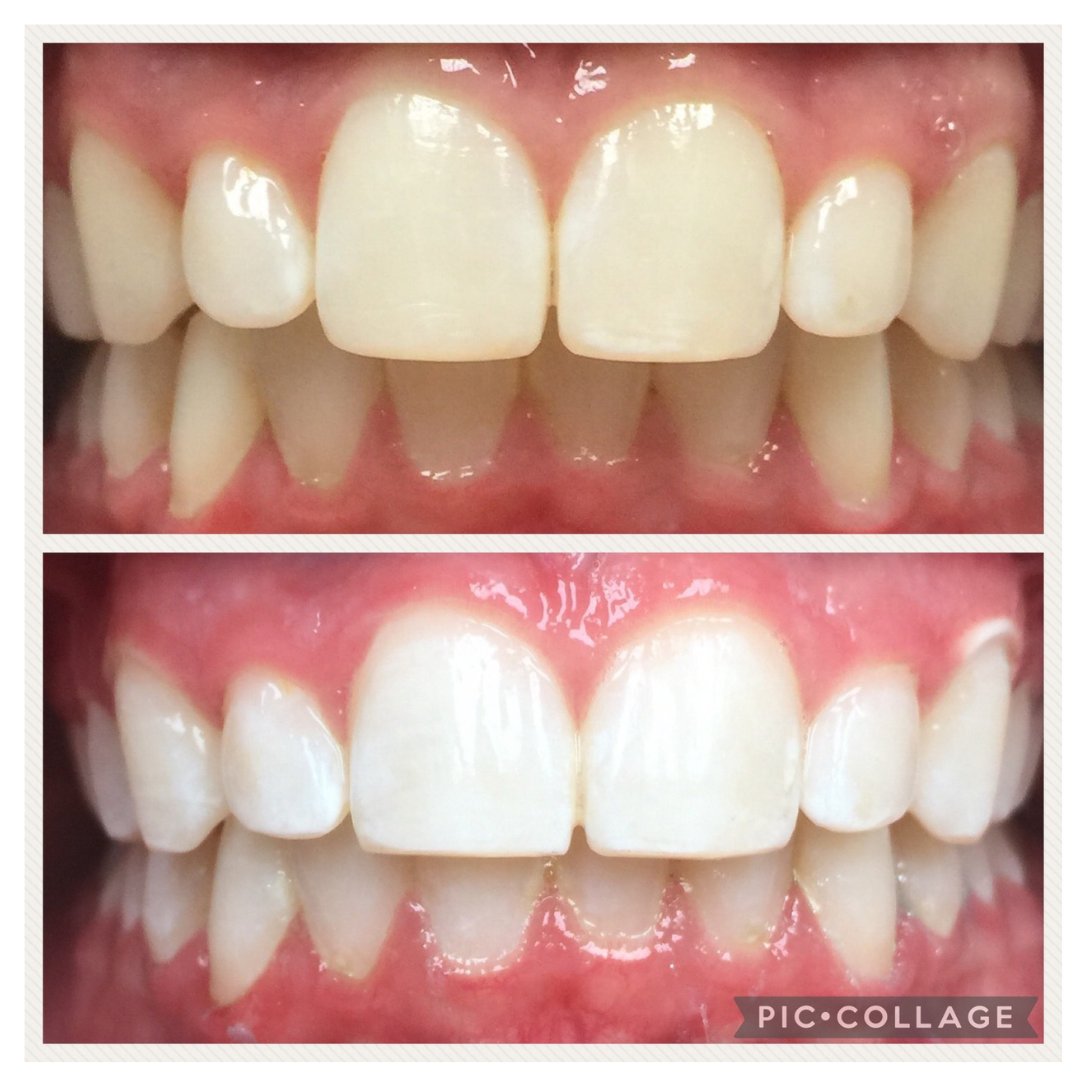 AllSmilesAllen's tweet image. 🦷⚪️😁 Want a bright and confident smile? Try in-office teeth whitening! 💪🏼💯 #teethwhitening #brightsmile #confidenceboost #dentalcare 🦷⚡️👍🏼