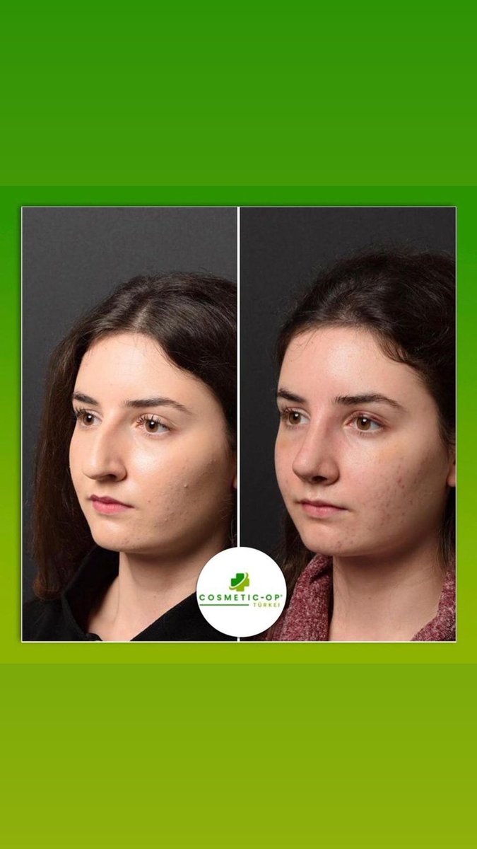 Cosmetic op Türkei #nasenop in der Türkei