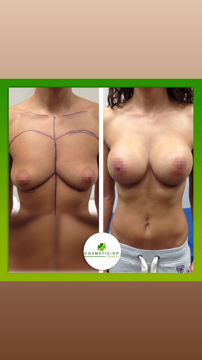 Cosmetic op Türkei #brustvergrösserung  in der Türkei