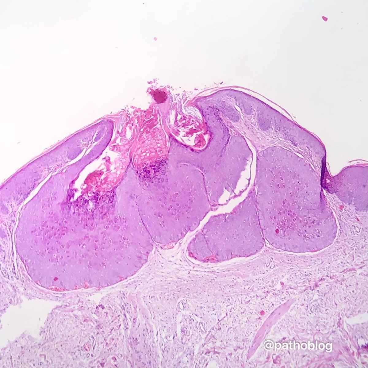 So cute and classic molluscum contagiosum 🌸

#pathtwitter #dermpath