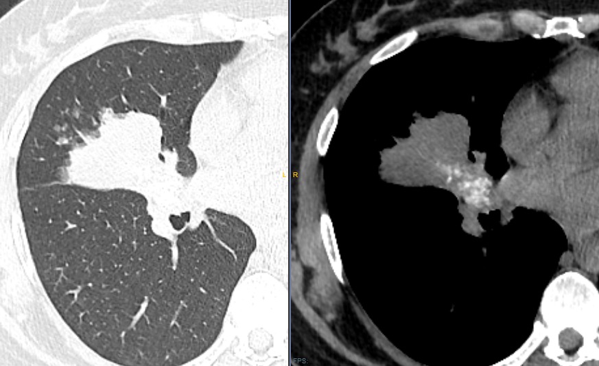 ♀️ 51 yo with morning productive cough... no priors. Any thoughts?

#radiology #radtwitter #MedTwitter #FOAMed #FOAMrad